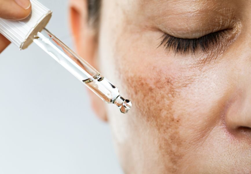 Why Pigmentation Gets Worse During Hormonal Changes